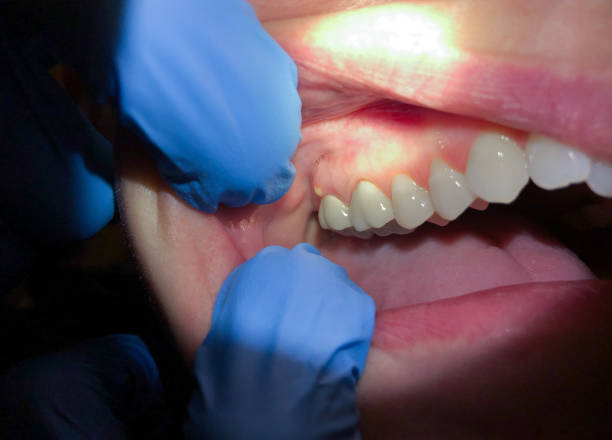 Best Emergency Wisdom Teeth Removal in Guntown, MS